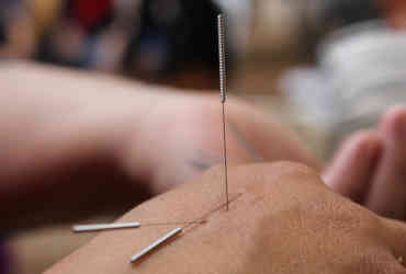 Acupuncture