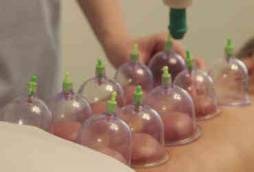 Cupping